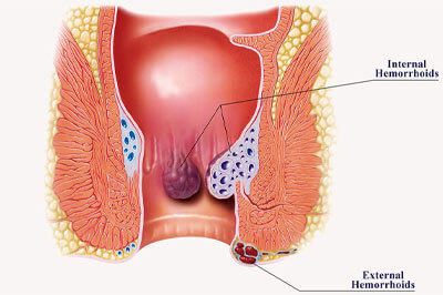 انواع بواسیر