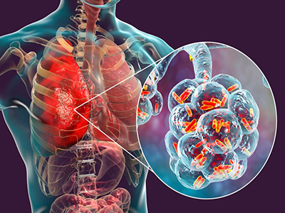 علائم ذات الریه
