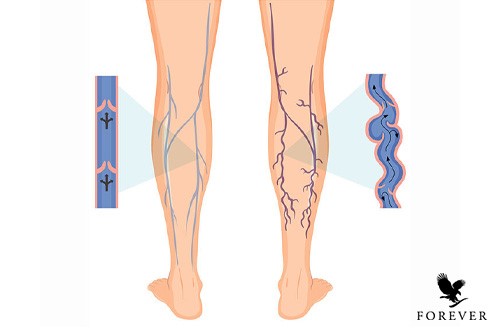 بیماری واریس